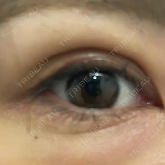 二重埋没 / 自然癒着法 Brandnew Beauty Clinic DAY 5 メイン用