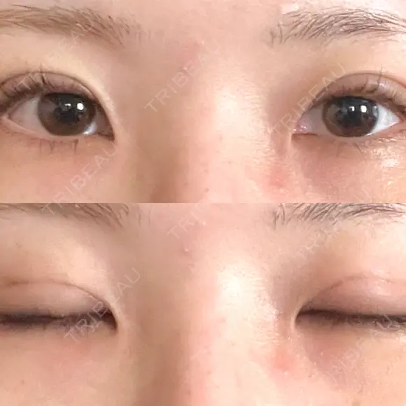 二重埋没 オアシス美容外科 DAY 8 メイン用