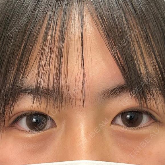 二重埋没 湘南美容クリニック 千葉センシティ院 AFTER メイン用