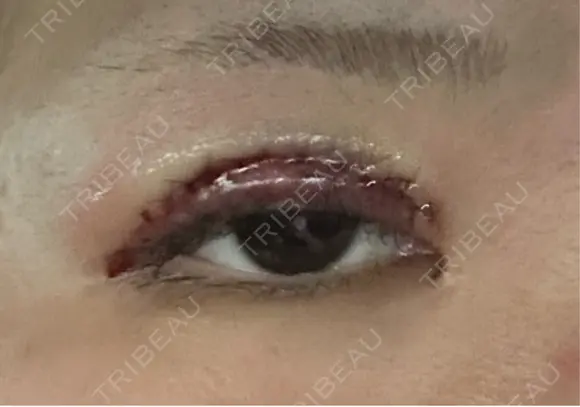 二重切開 聖心美容クリニック 広島院 DAY 0 メイン用