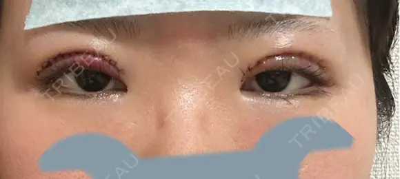 二重切開 聖心美容クリニック 広島院 DAY 1 メイン用