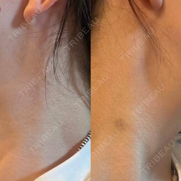 ボトックス（エラ・小顔） Natural Skin Clinic 自由ヶ丘院 AFTER メイン用