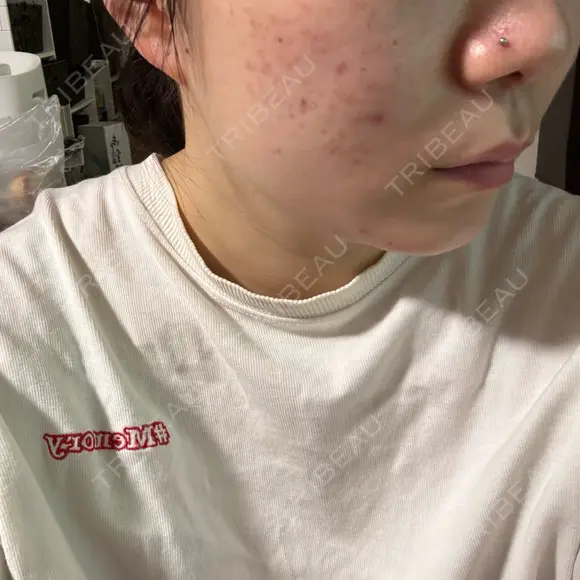 その他（肌） / ピーリング（ニキビ・毛穴） / ポテンツァ HAAB×DREAM BEAUTY CLINIC 大阪梅田院 DAY 7 メイン用