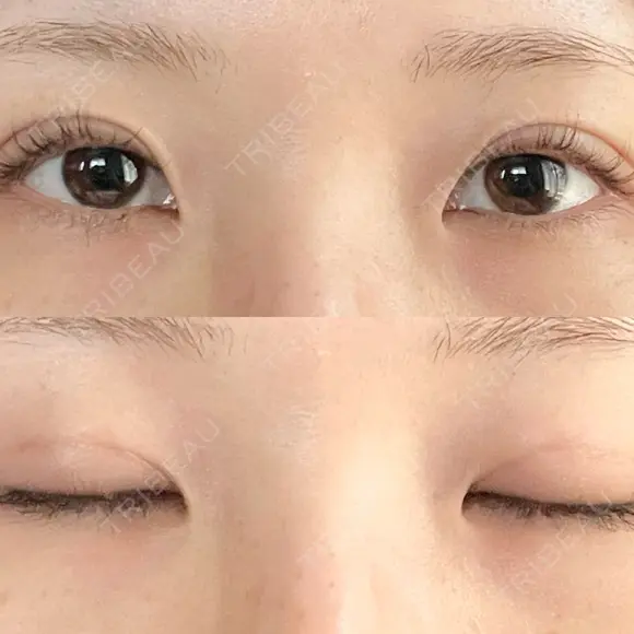 二重埋没 オアシス美容外科 DAY 9 メイン用