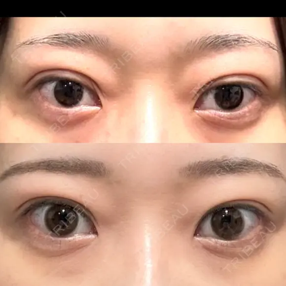 二重埋没 湘南美容クリニック 池袋東口院 DAY 14 メイン用