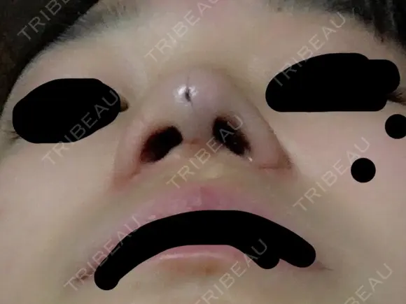 軟骨移植 三輪皮フ科形成外科 DAY 4 メイン用