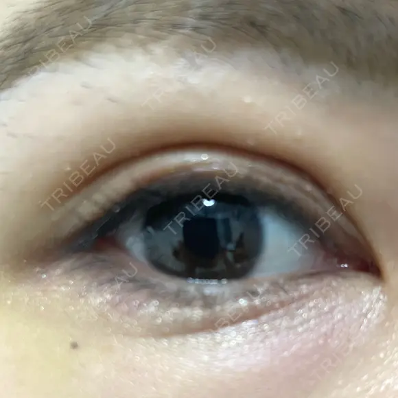 二重埋没 / 自然癒着法 Brandnew Beauty Clinic DAY 7 メイン用