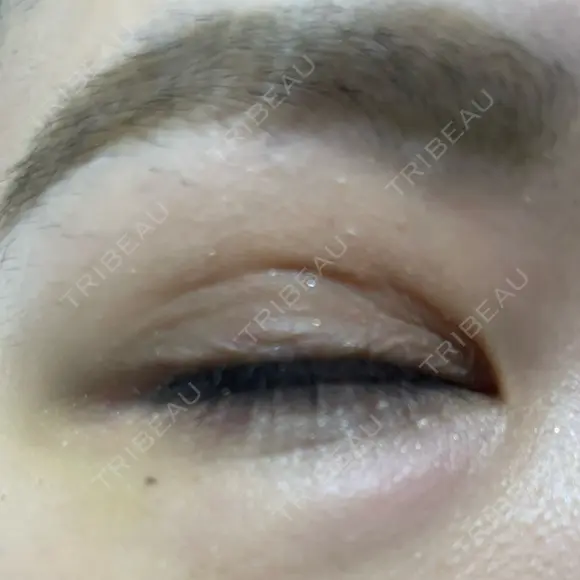 二重埋没 / 自然癒着法 Brandnew Beauty Clinic DAY 7 メイン用