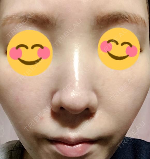 美肌レーザー みやた形成外科・皮ふクリニック DAY 11 メイン用