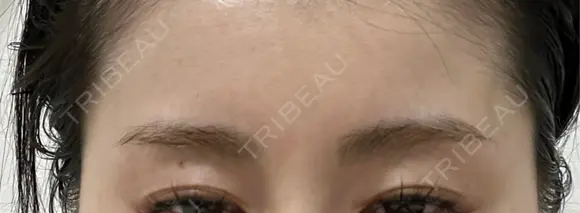 ボトックス（エラ・小顔） / ボトックス（肩） / シワ取りボトックス フォンタナクリニック天神 DAY 32 メイン用