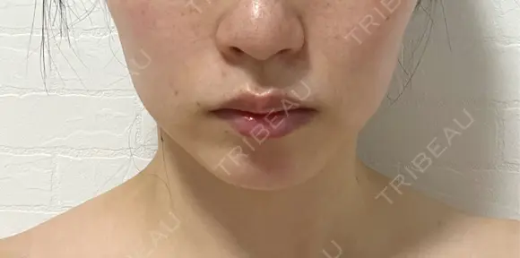 ボトックス（エラ・小顔） / ボトックス（肩） / シワ取りボトックス フォンタナクリニック天神 DAY 32 メイン用