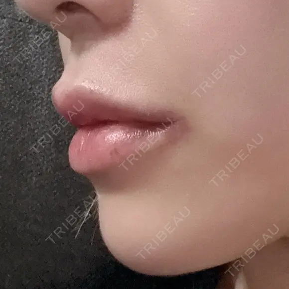 ヒアルロン酸注入（唇） Wi Clinic （ウィ クリニック）心斎橋院 AFTER メイン用