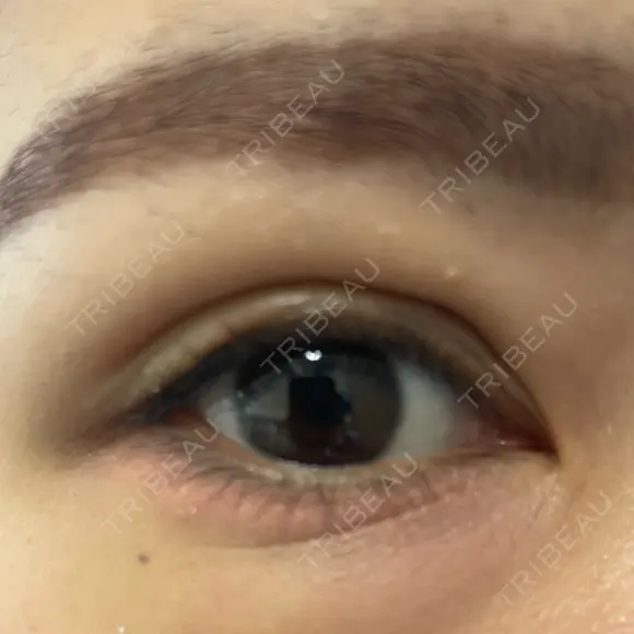 二重埋没 / 自然癒着法 Brandnew Beauty Clinic DAY 8 メイン用