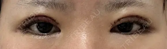 二重切開 聖心美容クリニック 広島院 DAY 2 メイン用