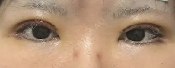 二重切開 聖心美容クリニック 広島院 DAY 3 メイン用