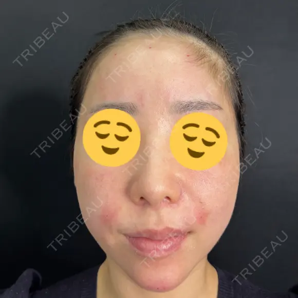 ヒアルロン酸注入（あご） / ヒアルロン酸注入（額） / ヒアルロン酸注入（鼻翼基部） 藤・ナチュレ美容クリニック 銀座院 AFTER メイン用