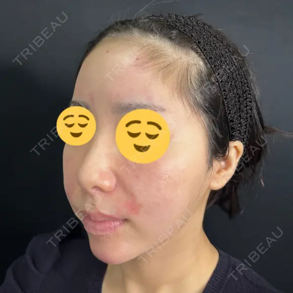 ヒアルロン酸注入（あご） / ヒアルロン酸注入（額） / ヒアルロン酸注入（鼻翼基部） 藤・ナチュレ美容クリニック 銀座院 DAY 0 メイン用