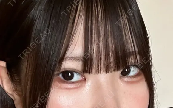 二重埋没 / 目頭切開 / 上まぶたの脂肪取り 9BeautyClinic AFTER メイン用