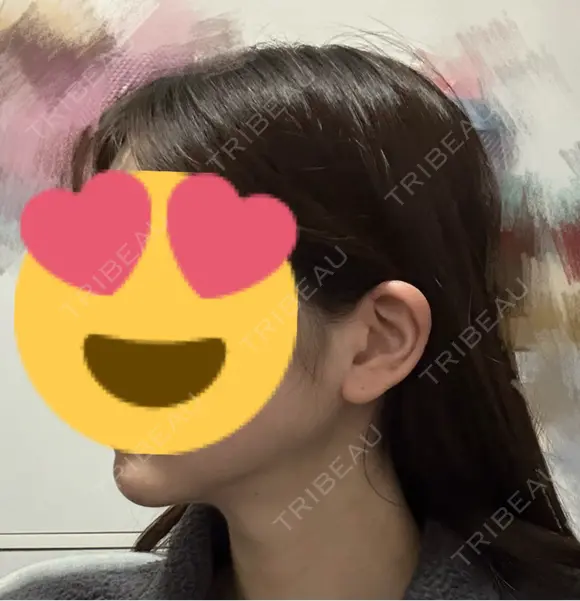 糸リフト / 脂肪吸引（顔） 脂肪吸引ラボトウキョウ DAY 81 メイン用