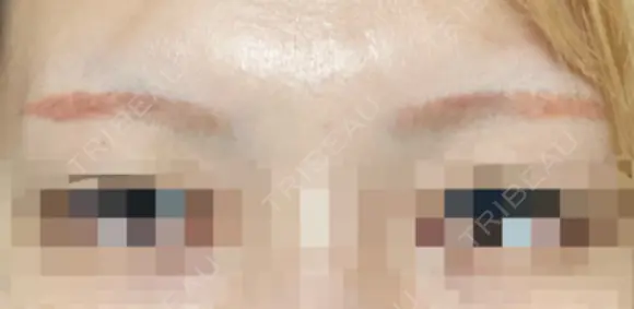 アートメイク除去・修正 表参道メディカルクリニック 新宿院 DAY 1 メイン用