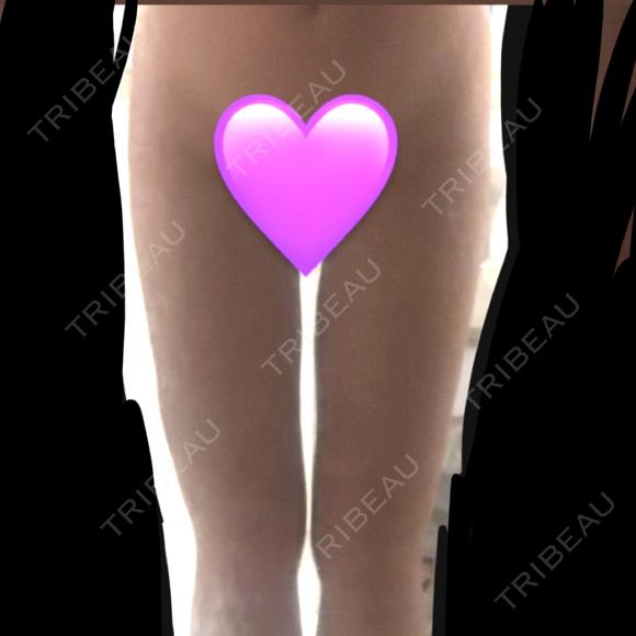 脂肪吸引（脚） オアシス美容外科 DAY 15 メイン用