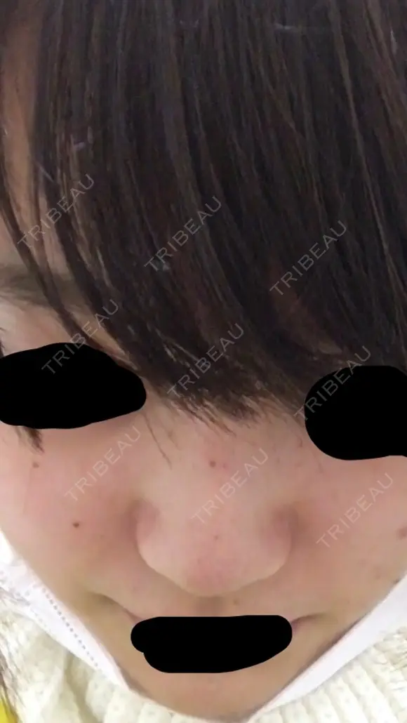 軟骨移植 三輪皮フ科形成外科 DAY 7 メイン用