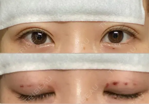 二重埋没 Stand by Beauty Clinic DAY 0 メイン用