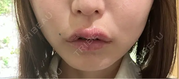 その他（口元） アネシス美容クリニック DAY 5 メイン用