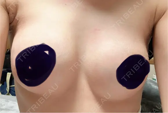 豊胸（シリコンバッグ） 共立美容外科 仙台院 AFTER メイン用