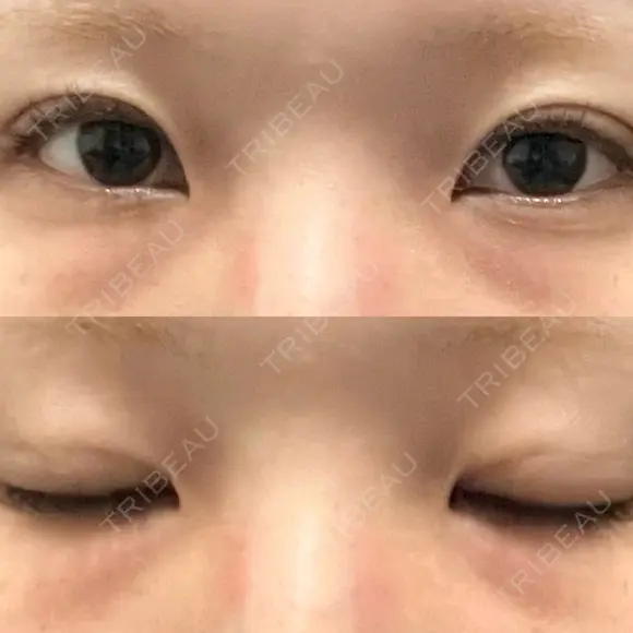 二重埋没 オアシス美容外科 AFTER メイン用