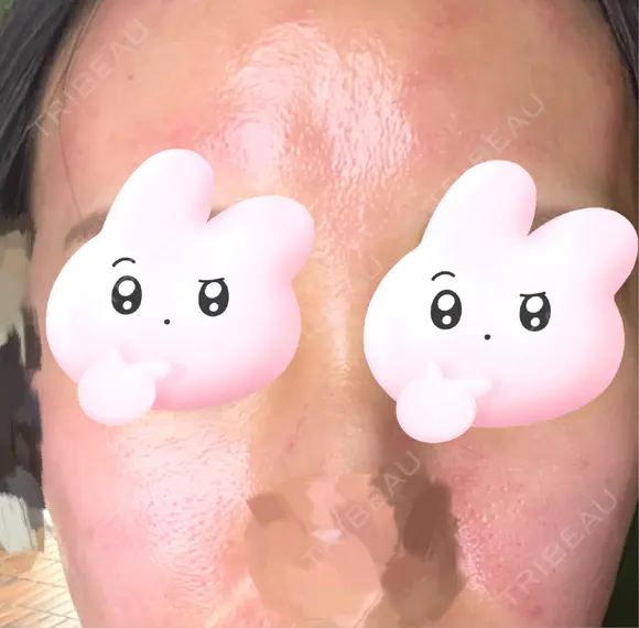 ヴァンパイアフェイシャル 東京美容クリニック 表参道本院 DAY 28 メイン用