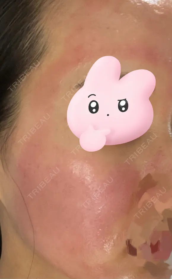 ヴァンパイアフェイシャル 東京美容クリニック 表参道本院 DAY 28 メイン用