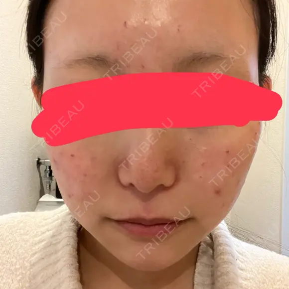 肌育注射（ジュベルックなど） 城本クリニック 池袋院 DAY 0 メイン用