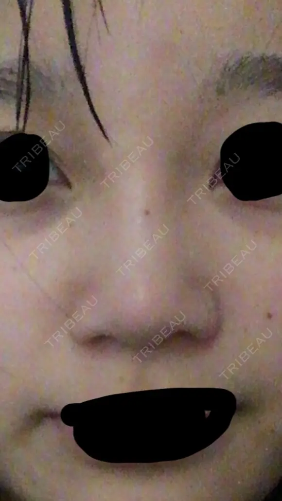 軟骨移植 三輪皮フ科形成外科 AFTER メイン用