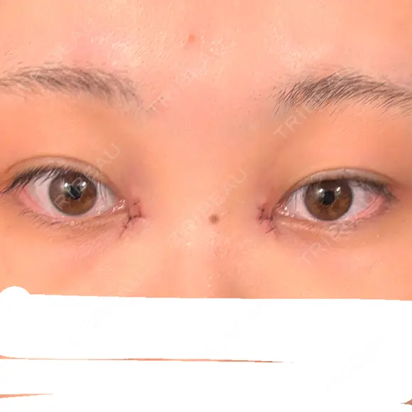 目頭切開 Brandnew Beauty Clinic DAY 1 メイン用