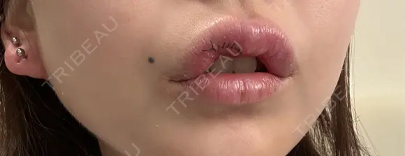 その他（口元） アネシス美容クリニック DAY 6 メイン用