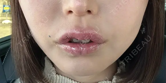 その他（口元） アネシス美容クリニック DAY 7 メイン用