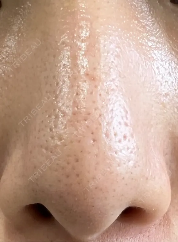 アグネス 日本美容・医療クリニック 六本木院 AFTER メイン用