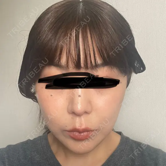 鼻尖形成（切開） / 小鼻縮小（切開） / 軟骨移植 ASTRA BEAUTY CLINIC DAY 15 メイン用