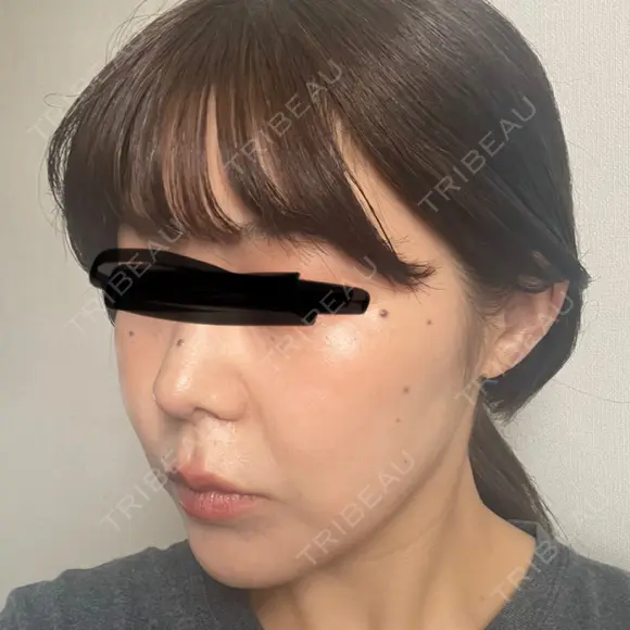 鼻尖形成（切開） / 小鼻縮小（切開） / 軟骨移植 ASTRA BEAUTY CLINIC DAY 15 メイン用