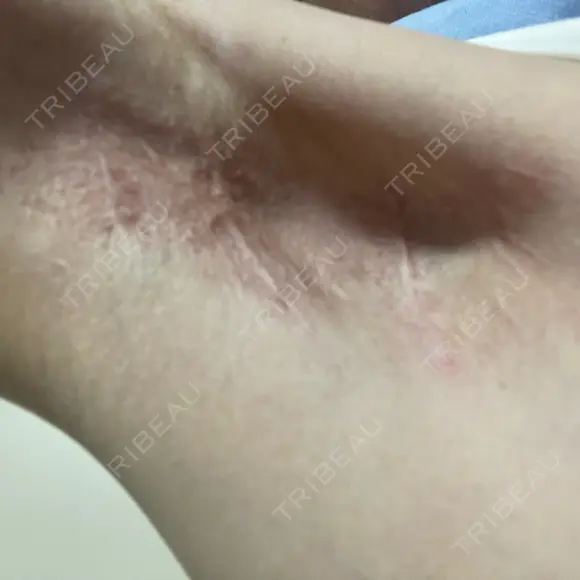 ワキ汗治療（切開） 石倉クリニック 水戸院 DAY 334 メイン用