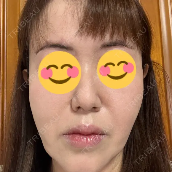 ハイフ（顔） 銀座TSUBAKIクリニック AFTER メイン用