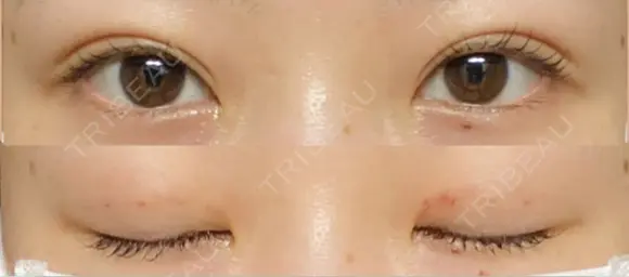 二重埋没 Stand by Beauty Clinic DAY 3 メイン用