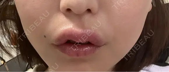 その他（口元） アネシス美容クリニック DAY 8 メイン用