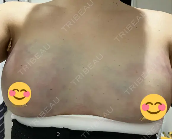 脂肪吸引（お腹） / 豊胸（脂肪注入） / 脂肪吸引（腰） Lipo Clinic omotesando DAY 3 メイン用