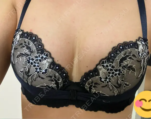 脂肪吸引（お腹） / 豊胸（脂肪注入） / 脂肪吸引（腰） Lipo Clinic omotesando AFTER メイン用