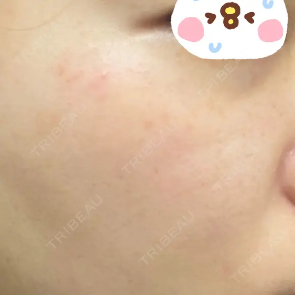 ピーリング（ニキビ・毛穴） / イオン導入 / ルメッカ ルラ美容クリニック 上野院 DAY 1 メイン用