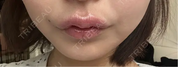 その他（口元） アネシス美容クリニック AFTER メイン用