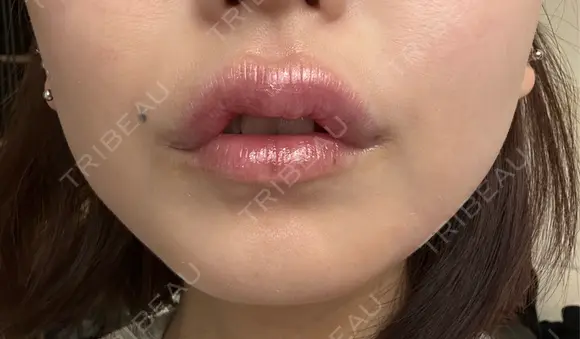 その他（口元） アネシス美容クリニック DAY 10 メイン用