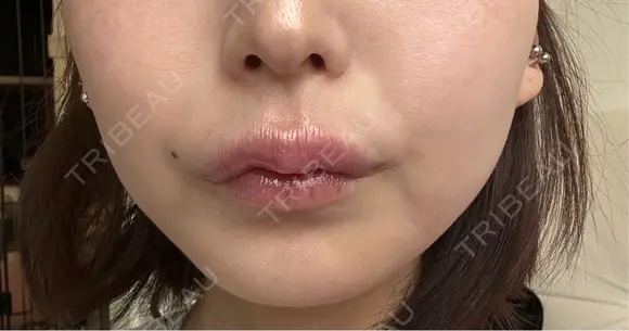 その他（口元） アネシス美容クリニック DAY 10 メイン用